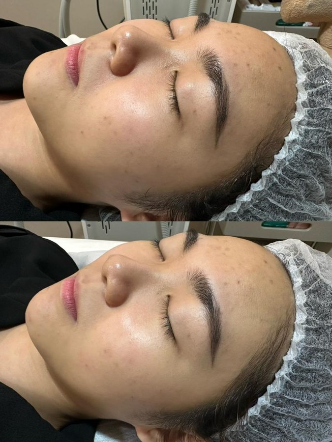 SPECTRA 4 Hair Removal result 1